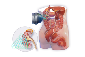 Extracorporeal Shockwave Lithotripsy Diagram