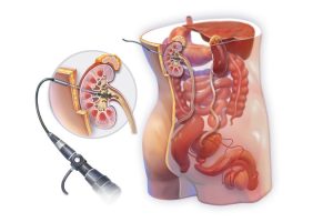 Percutaneous Nephrolithotomy Diagram