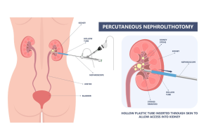 Percutaneous Nephrolithotomy Diagram