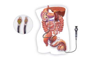 Ureteroscopy Diagram